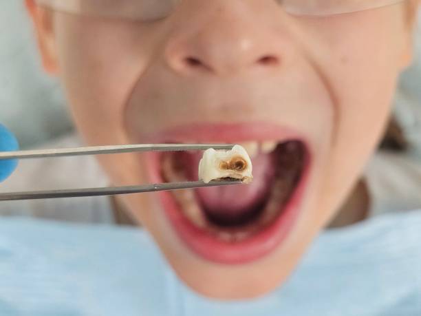Best Emergency Dentist for Lost Fillings or Crowns in Twinsburg Heights, OH